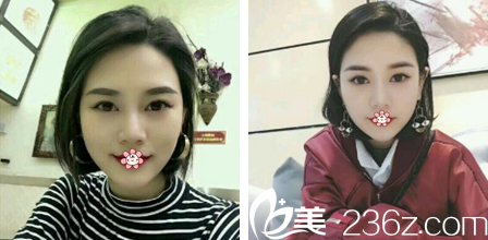 烏魯木齊華美整形雙眼皮加硅膠假體隆鼻術后一個月 烏魯木齊華美整形雙眼皮加硅膠假體隆鼻術后一個月