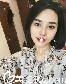 做完雙眼皮+硅膠假體隆鼻我才知道不只新疆華美醫(yī)院靠譜杰也挺靠譜。