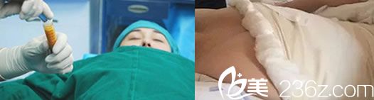 自體脂肪隆胸手術(shù)第2天 自體脂肪隆胸手術(shù)第2天