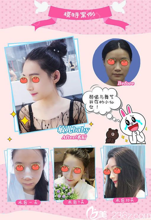 金華玥萊美高順福隆鼻案例