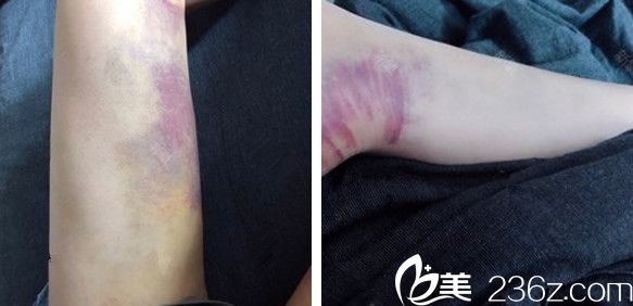 在合肥華美整形做大腿抽脂術(shù)后第10天恢復情況