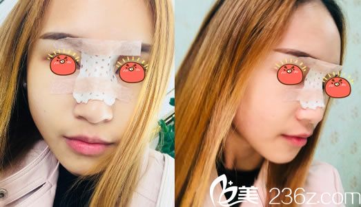 金華玥萊美做完隆鼻3天恢復(fù)照