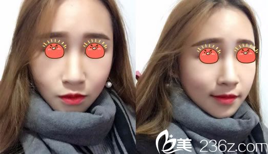 做完玥美生態(tài)鼻綜合7天恢復(fù)照