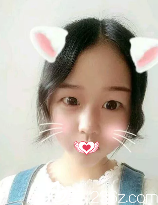 術(shù)前單眼皮無神 術(shù)前單眼皮無神