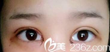 剛做完眼綜合眼睛稍腫 剛做完眼綜合眼睛稍腫