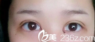 雙眼皮恢復(fù)7天拆線后消腫 雙眼皮恢復(fù)7天拆線后消腫