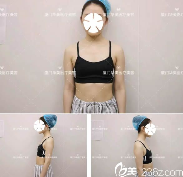 在廈門華美整形醫(yī)院隆胸術(shù)前照 在廈門華美整形醫(yī)院隆胸術(shù)前照