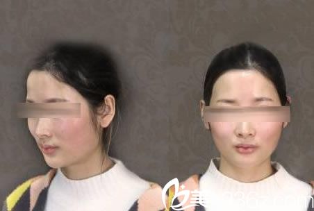 在金華玥萊美做自體脂肪填充前 在金華玥萊美做自體脂肪填充前