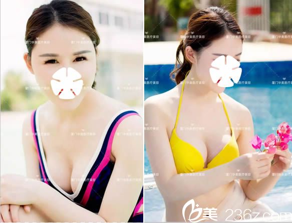 我在網(wǎng)上看過(guò)廈門整形醫(yī)院的排行榜后,去廈門華美讓賈虹做了曼托傲諾拉假體隆胸