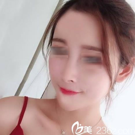 做完自體脂肪填充15天恢復(fù)照 做完自體脂肪填充15天恢復(fù)照