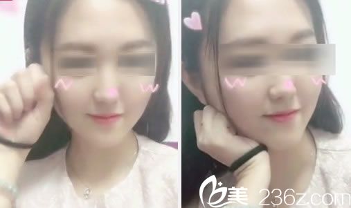 金華玥萊美做脂肪填充30天<span style= 金華玥萊美做脂肪填充30天<span style=