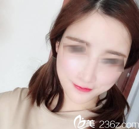 自從知道脂肪填充這個(gè)手術(shù)就一直想做,終于來金華玥萊美做了腰腹抽脂和全臉脂肪填充