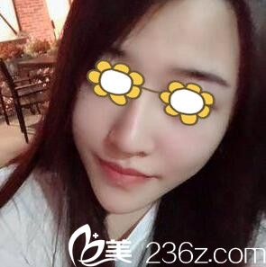 玻尿酸豐下巴第三天照 玻尿酸豐下巴第三天照