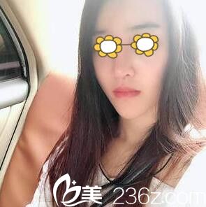 選擇玻尿酸墊下巴第十天效果 選擇玻尿酸墊下巴第十天效果