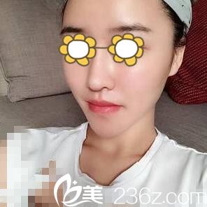 看我在韓國美&美微整形醫(yī)院注射玻尿酸豐下巴1個月了，秀秀效果