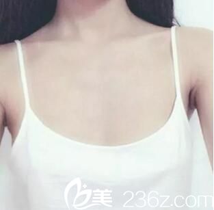 假體隆胸術(shù)前 假體隆胸術(shù)前