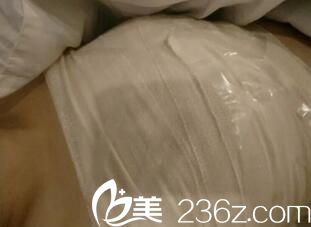 假體隆胸手術(shù)2天 假體隆胸手術(shù)2天