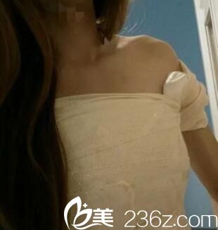 在鄭州集美做假體隆胸術(shù)后3天 在鄭州集美做假體隆胸術(shù)后3天