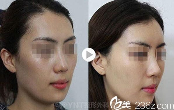 韓國(guó)YNT整形<span style= 韓國(guó)YNT整形<span style=