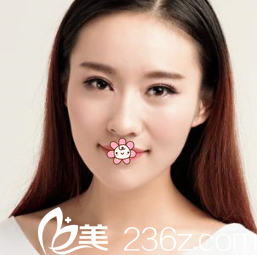 文晶煥雙眼皮術(shù)后半個月