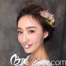 韓國IRIS整形外科文晶煥雙眼皮術(shù)后40天效果