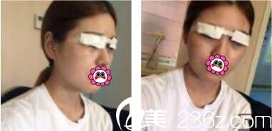 韓國李韓率整形外科李翰率韓式雙眼皮真人案例術(shù)后天