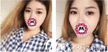 韓國李韓率整形外科李翰率韓式雙眼皮真人案例術(shù)后十五天