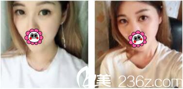 韓國李韓率整形外科李翰率韓式雙眼皮真人案例術(shù)后一個月