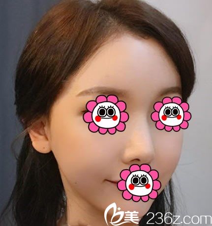 韓國YNT整形醫(yī)院鼻部綜合整形手術(shù)前 鼻部綜合整形手術(shù)填充后對比圖 韓國YNT整形醫(yī)院鼻部綜合整形手術(shù)前 鼻部綜合整形手術(shù)填充后對比圖