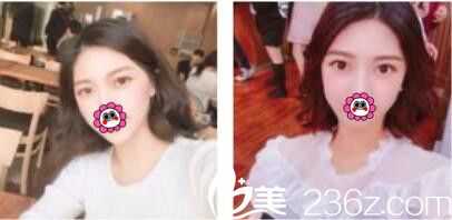 一年前去韓國李喜文做了韓式雙眼皮，沒想到這么長時間保持的還很好