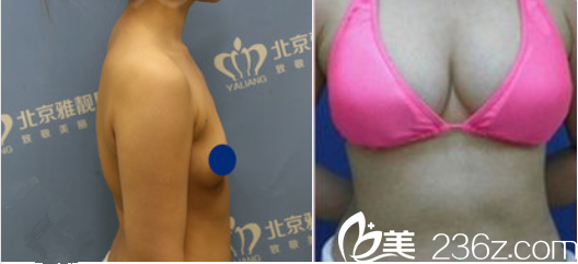 北京雅靚假體隆胸案例 北京雅靚假體隆胸案例