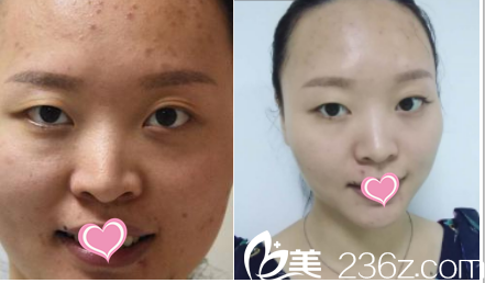 北京雅靚黃金微針美膚效果 北京雅靚黃金微針美膚效果