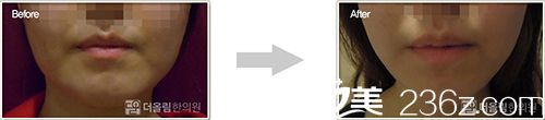韓國(guó)冬柏美姿韓方美容V-line面部提升術(shù)案例對(duì)比圖