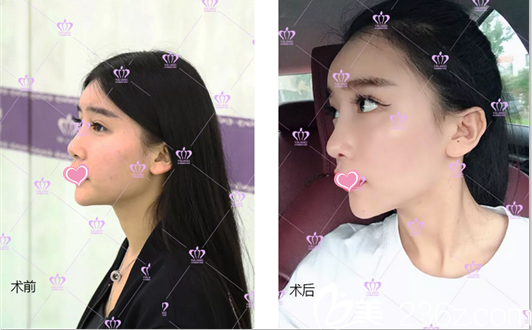 北京雅靚鼻綜合隆鼻案例 北京雅靚鼻綜合隆鼻案例