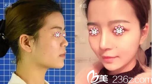 譚亮隆鼻案例 譚亮隆鼻案例