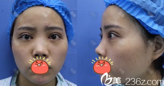 找寧波壹加壹郭光燁做隆鼻前 找寧波壹加壹郭光燁做隆鼻前