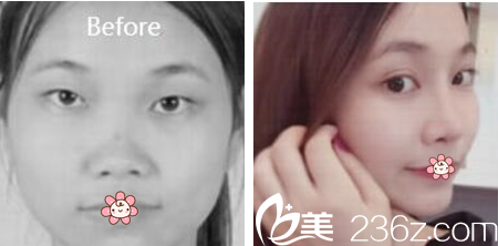 烏魯木齊伊麗莎白整形張峰醫(yī)生眼綜合實例圖 烏魯木齊伊麗莎白整形張峰醫(yī)生眼綜合實例圖