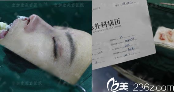 寧波壹加壹剛做完隆鼻的圖片 寧波壹加壹剛做完隆鼻的圖片