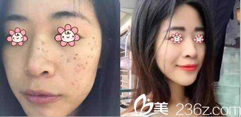 張國寧醫(yī)生激光祛斑案例 張國寧醫(yī)生激光祛斑案例