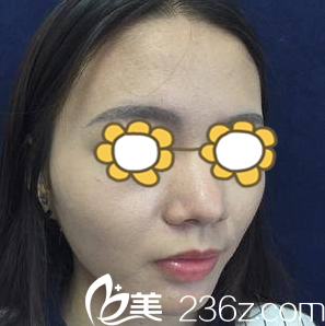 做鼻整形術(shù)前照 做鼻整形術(shù)前照