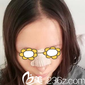 做自體耳軟骨隆鼻第五天 做自體耳軟骨隆鼻第五天