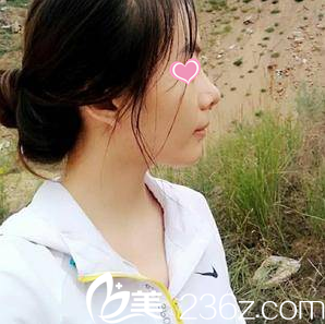 做的鼻整形術(shù)后半個(gè)月 做的鼻整形術(shù)后半個(gè)月