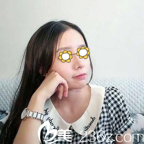 分享我找長沙欣顏醫(yī)療美容醫(yī)院做的自體耳軟骨鼻綜合術(shù)后一個月恢復效果