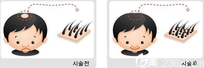 韓國(guó)毛尚毛發(fā)移植醫(yī)院毛發(fā)移植原理 韓國(guó)毛尚毛發(fā)移植醫(yī)院毛發(fā)移植原理