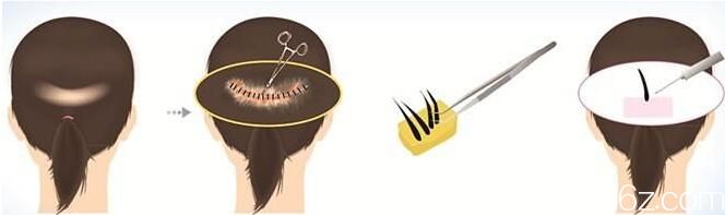 韓國(guó)毛尚毛發(fā)移植醫(yī)院毛發(fā)移植方法 韓國(guó)毛尚毛發(fā)移植醫(yī)院毛發(fā)移植方法