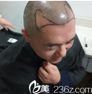 廣州壹加壹游鳳軍發(fā)際線種植術(shù)前 廣州壹加壹游鳳軍發(fā)際線種植術(shù)前