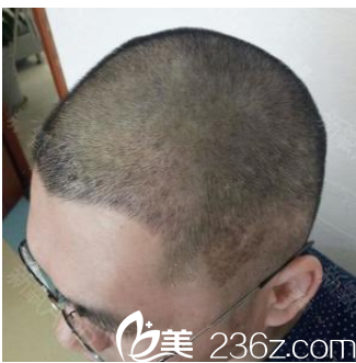 廣州壹加壹游鳳軍發(fā)際線種植術(shù)后10天效果 廣州壹加壹游鳳軍發(fā)際線種植術(shù)后10天效果