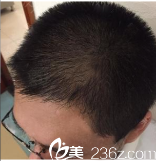 廣州植發(fā)哪家好？看我花1萬多元找廣州壹加壹游鳳軍做的發(fā)際線種植效果怎么樣