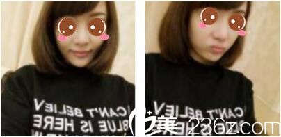 韓國(guó)毛尚毛發(fā)移植技術(shù)怎么樣？看我半年前找樸正一做的發(fā)際線種植