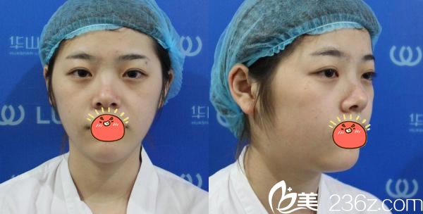 在杭州連天美做脂肪填充前 在杭州連天美做脂肪填充前